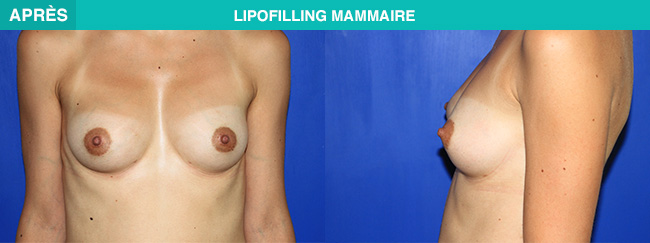 APRES Lipofilling mammaire