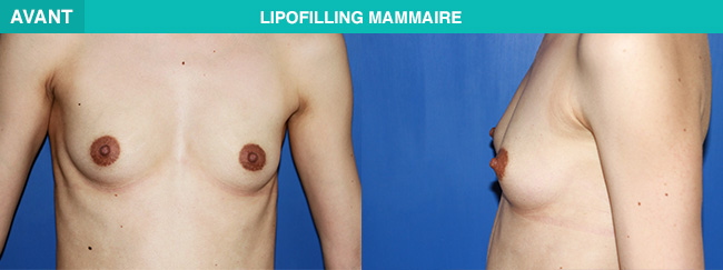AVANT APRES Lipofilling mammaire