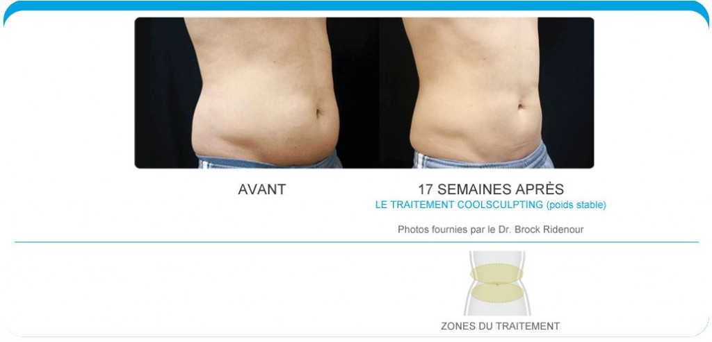 coolsculpting nantes 44