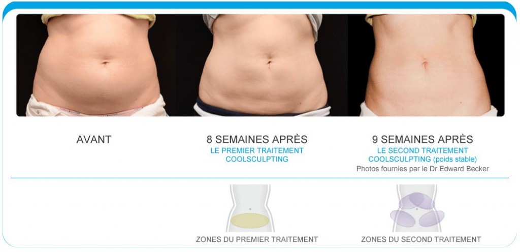 coolsculpting nantes 44