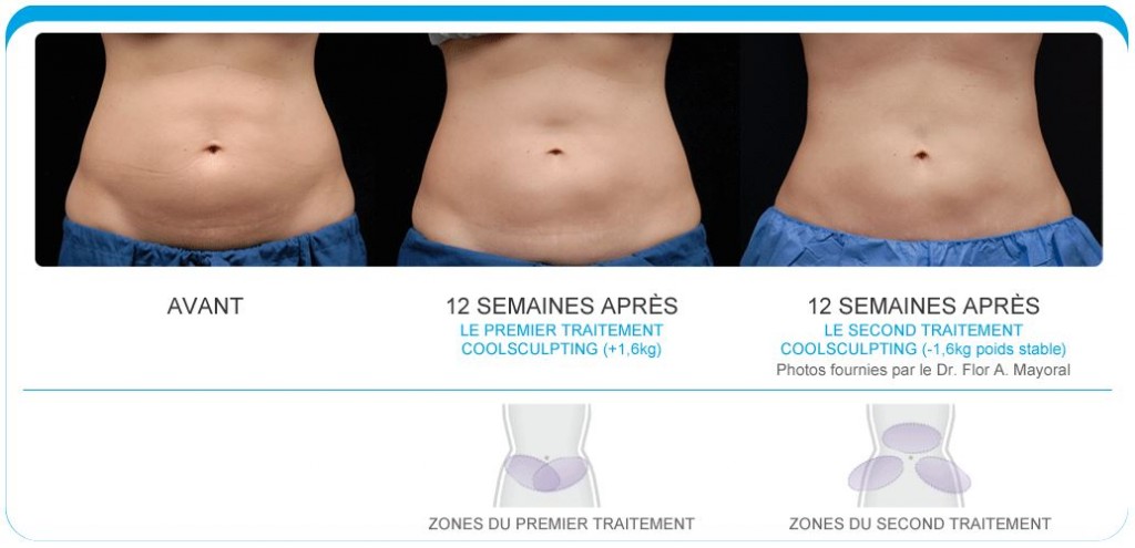 coolsculpting nantes 44