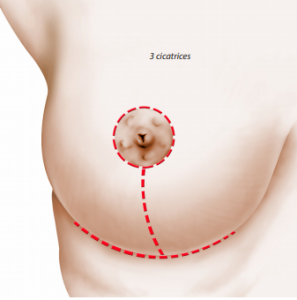 ptose mammaire 3 cicatrices