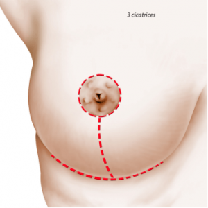 Cicatrice réduction mammaire