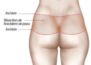 schéma bodylift phase dorsale