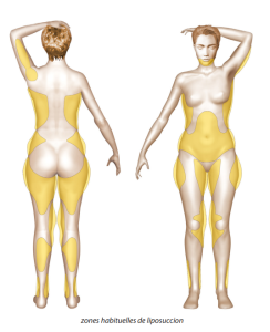 zones lipoaspiration SoFCPRE